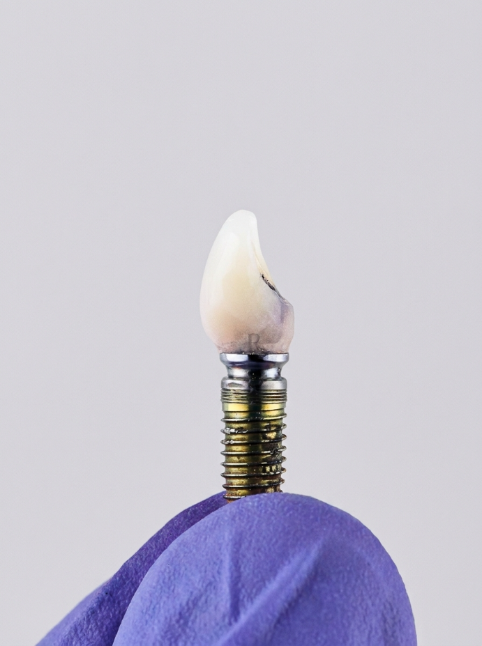 Implant-Supported Crown / Bridge
